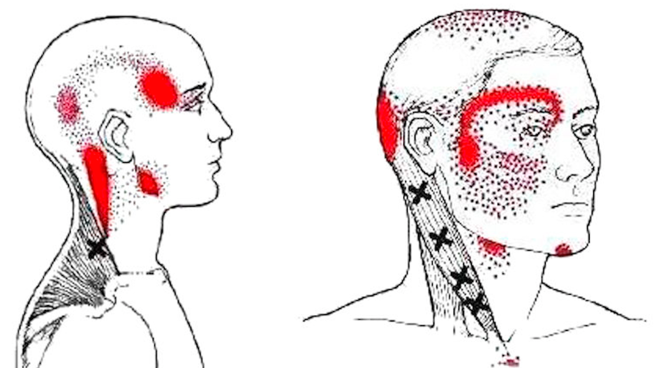 tratamiento migraña Mallorca